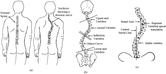 Difference between normal spine and scoliosis with a thoracic curve